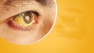 Hamirpur: हमीरपुर में दूषित पानी से फैला पीलिया, 9 गांवों में 44 लोग बीमार; सैंपल रिपोर्ट ने खोली विभाग की पोल