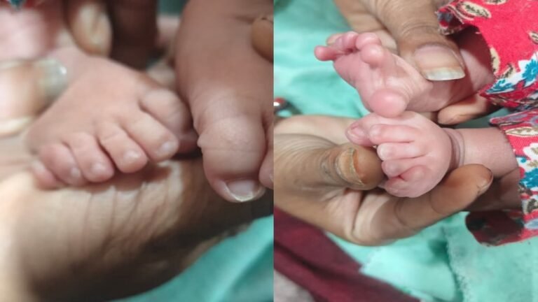 Kangra: पालमपुर अस्पताल में जन्मा अनोखा बच्चा, दोनों हाथ-पैरों में छह-छह उंगलियां; जानें डॉक्टरों ने क्या कहा
